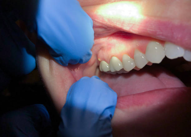 Best Emergency Broken Tooth Repair in The Plains, OH